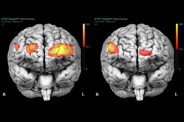 borderline brain