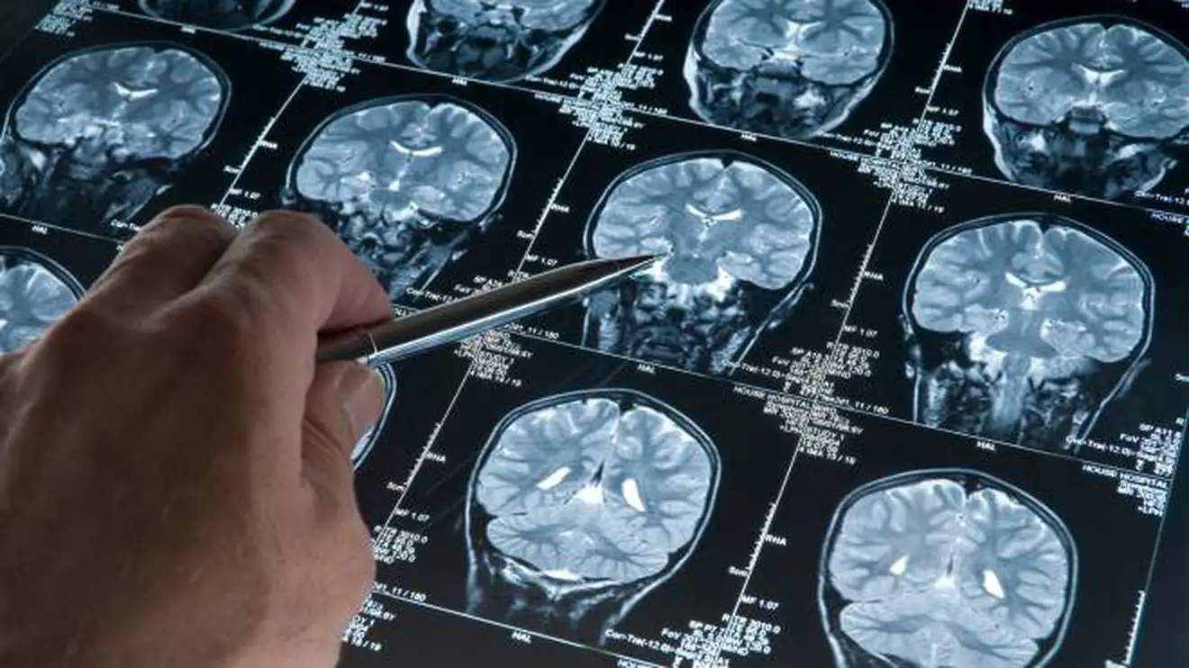 cervello con alzheimer: immagini di diagnostica strumentale