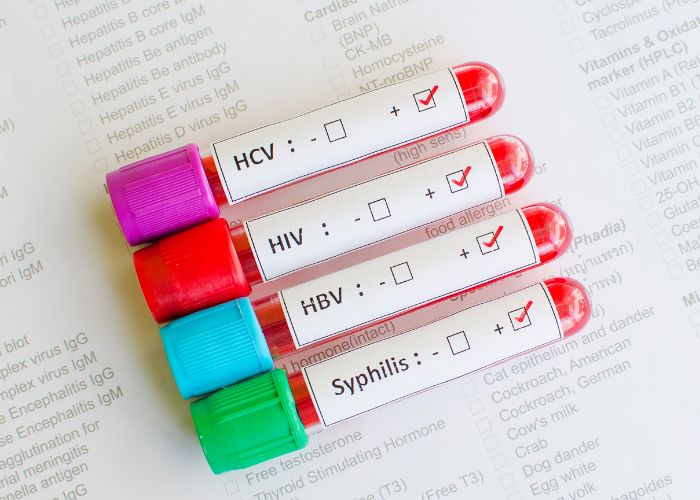 malattie sessualmente trasmesse HIV